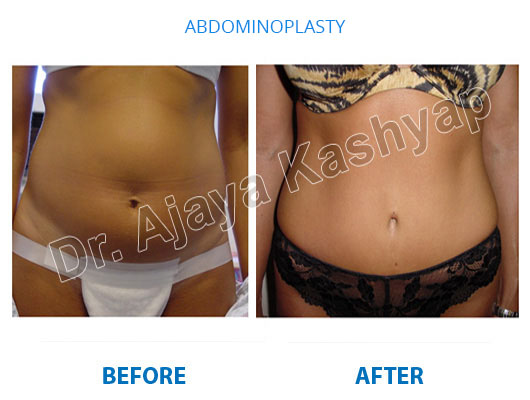 fat removal surgery cost